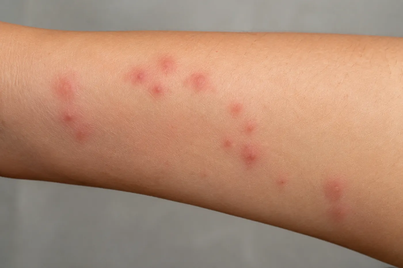 Cluster of red, raised bed bug bites in a line on a person's forearm